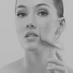 Acne-Treatment-London London Laser Clinic Acne Treatment Services London