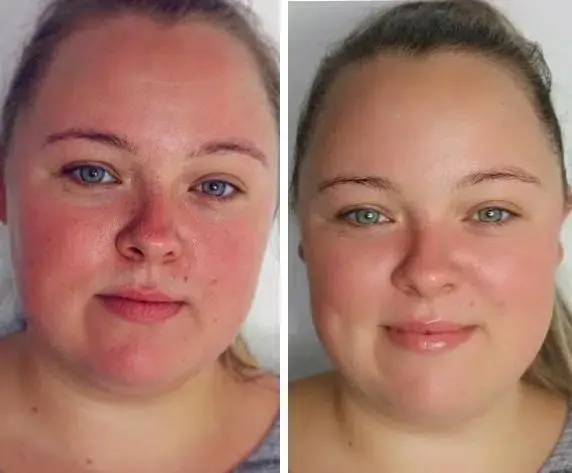 Hydro O2 Facial Treatment