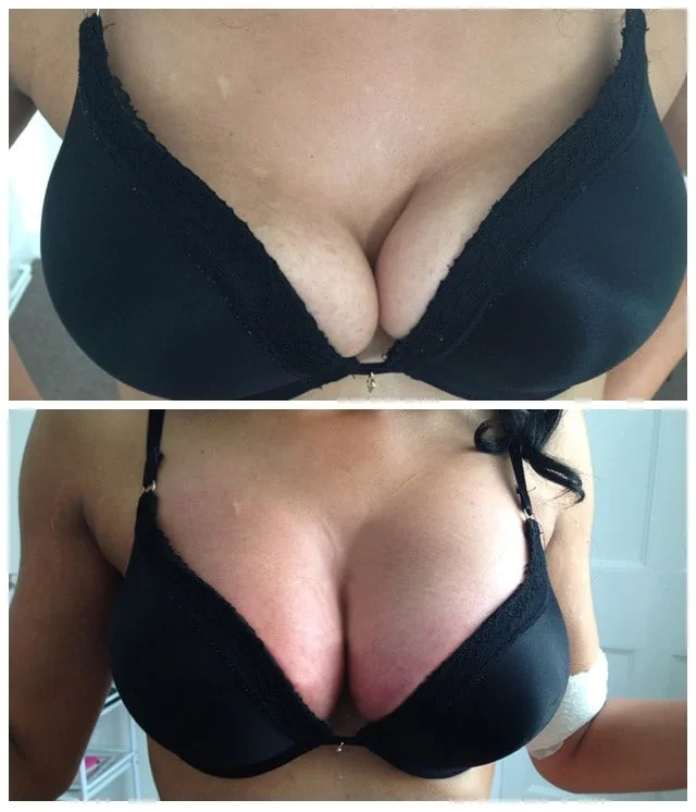 breast-Lift-Before-And-After-2 Non-surgical breast enhancement Treatment & Butt Lift before
