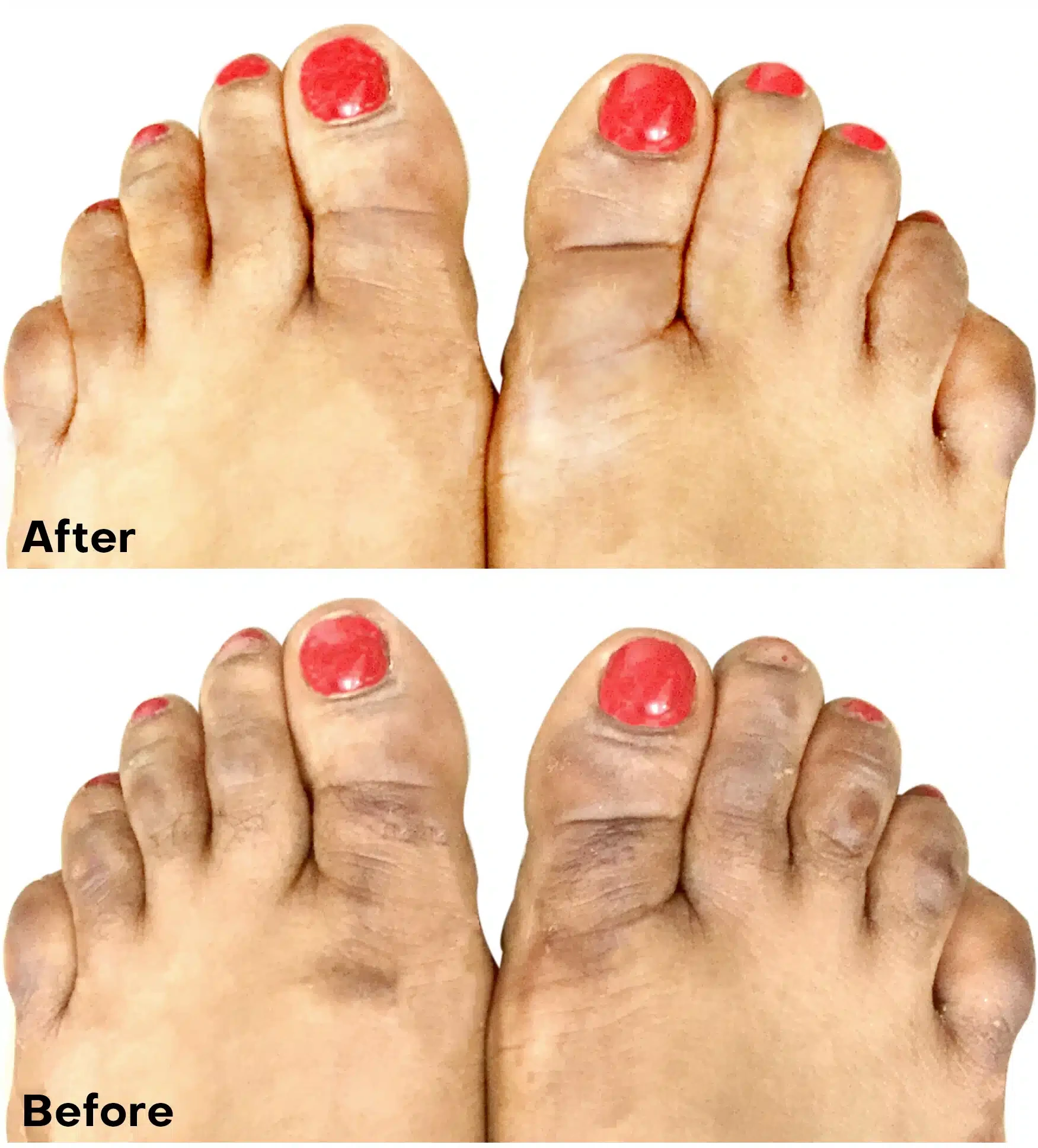 Feet and toe pigmentation Dark Underarms and Feet Treatment Feet and toe pigmentation