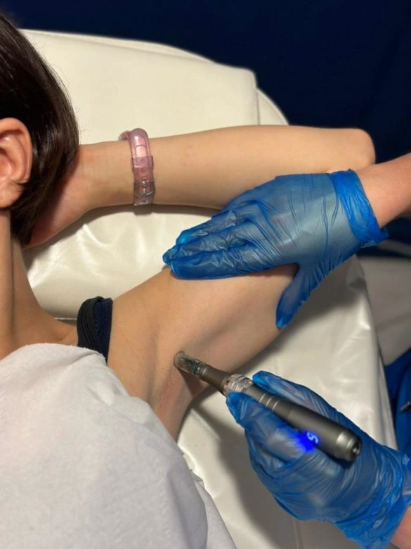 Treatments available for dark skin on the under arm Treatments available for dark skin on the under arm