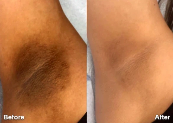 Treatments available for dark skin on the under arm Treatments available for dark skin on the under arm